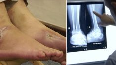 【奇跡の回復】殺し屋に自動小銃で撃たれた男性　3か月で復帰＝南ア